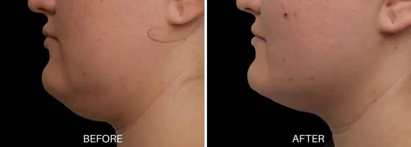EMface double chin before and after results