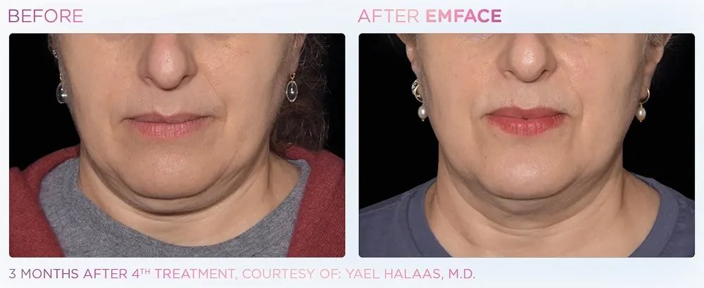 EmFace before and after results at Dermatology Laser Center & Medispa, Owings Mills, MD