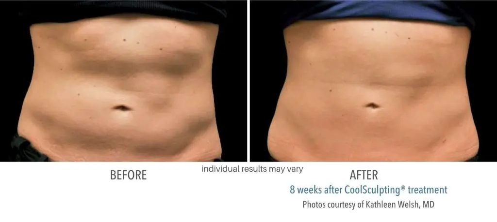 CoolSculpting before and after results at Dermatology Laser Center & Medispa, Owings Mills, MD