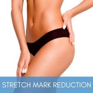 Woman's lower abdomen and thighs with smooth and clear skin after stretch mark reduction.