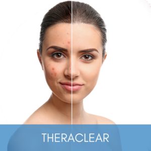 Womans face showing before and after results from theraclear.