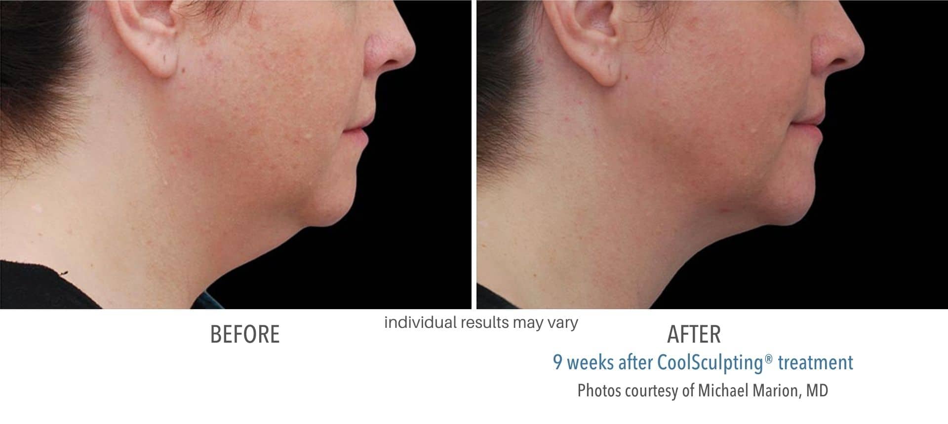 CoolSculpting double chin treatment before and after