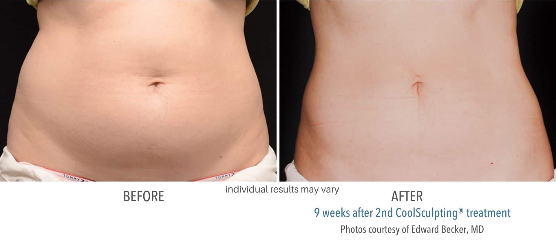 CoolSculpting belly fat treatment before and after