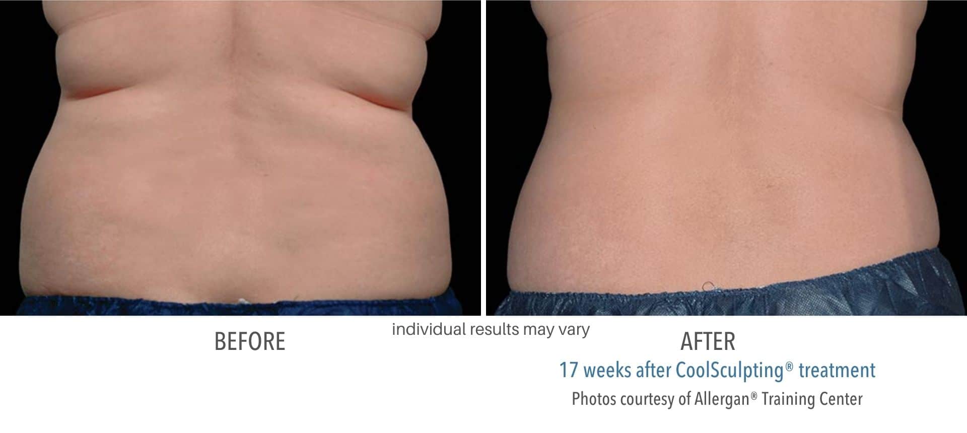 CoolSculpting back fat treatment before and after