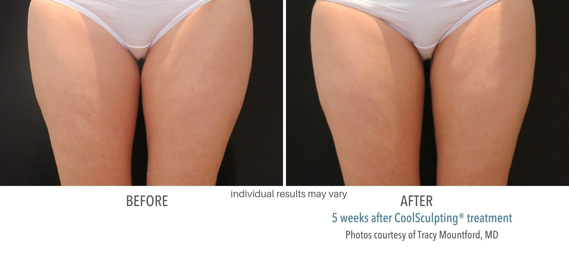 CoolSculpting thighs treatment before and after
