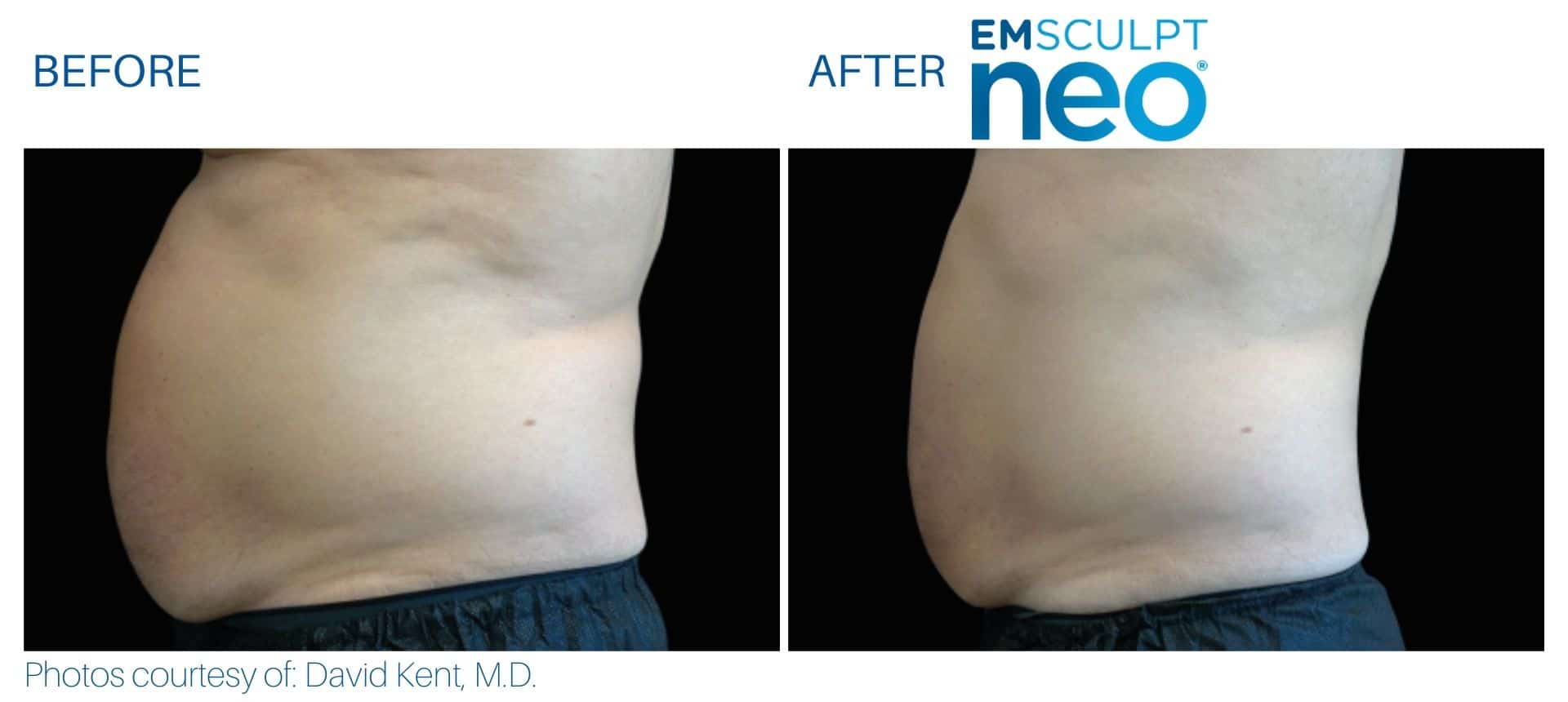 Emsculpt neo abdomen treatment before and after