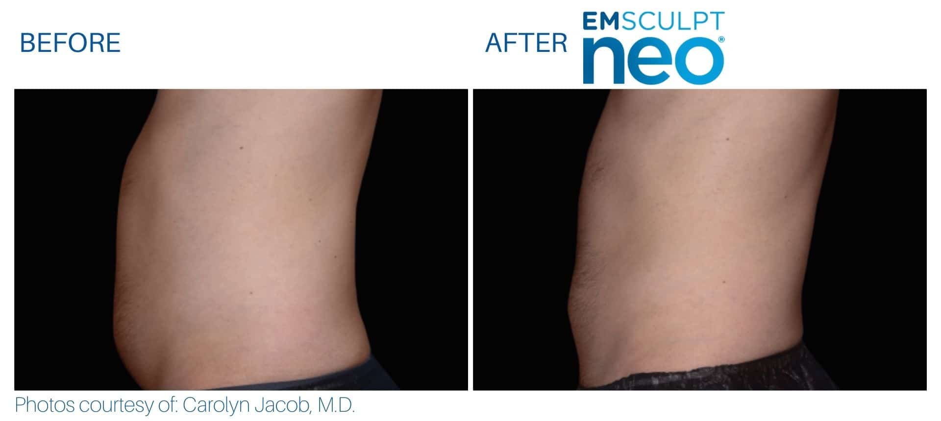 Emsculpt neo belly fat treatment before and after