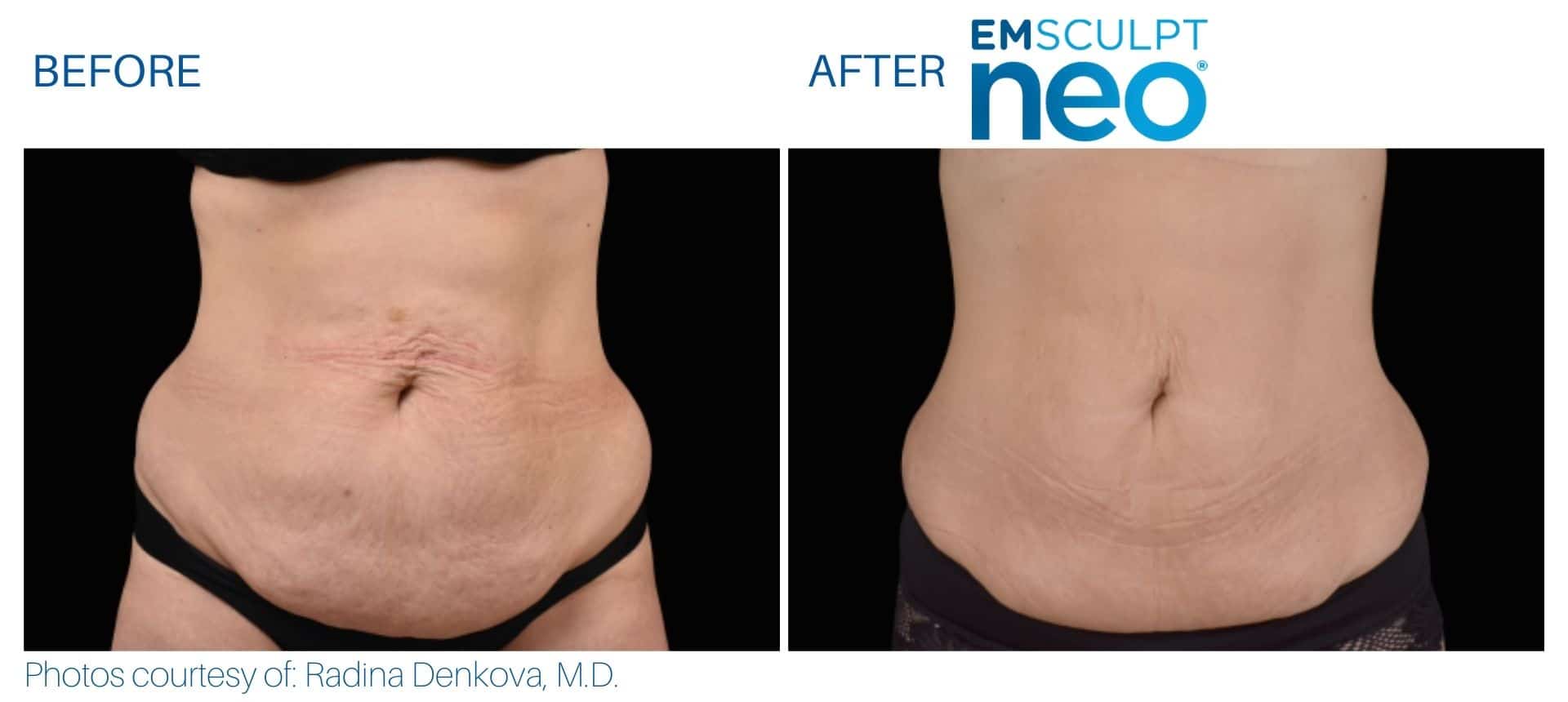 Emsculpt neo stomach treatment before and after