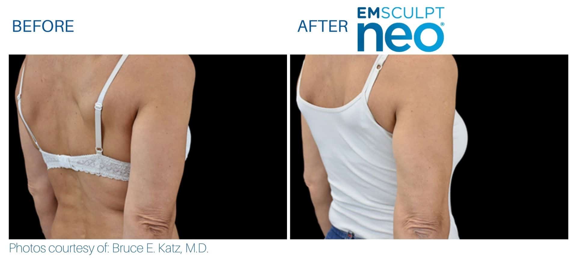 Emsculpt neo arms treatment before and after