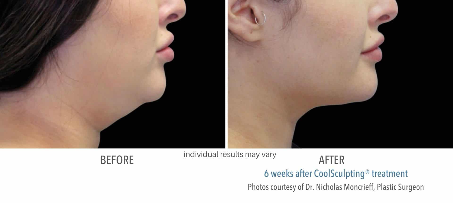coolsculpting treatment double chin