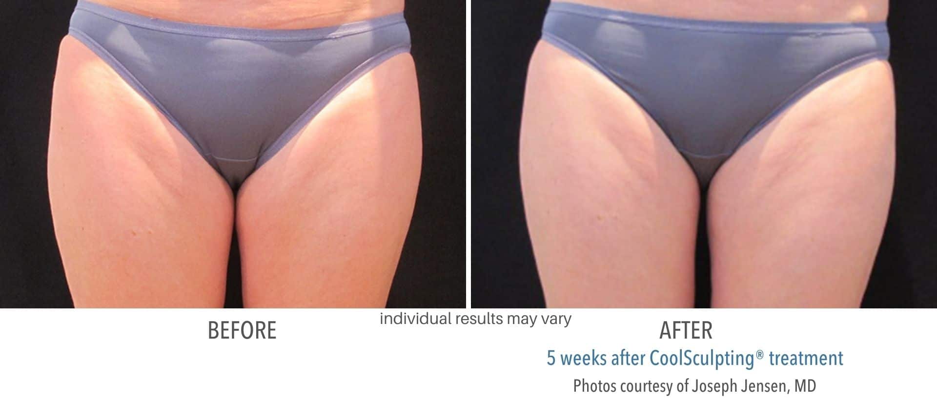coolsculpting treatment inner thighs
