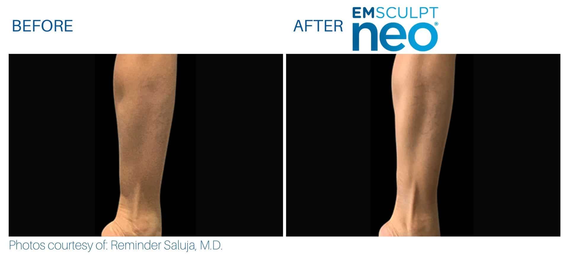 Emsculpt neo calf treatment before and after