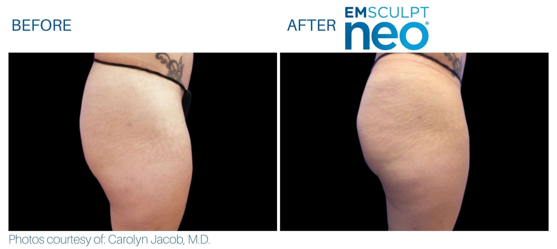 Emsculpt neo buttocks treatment
