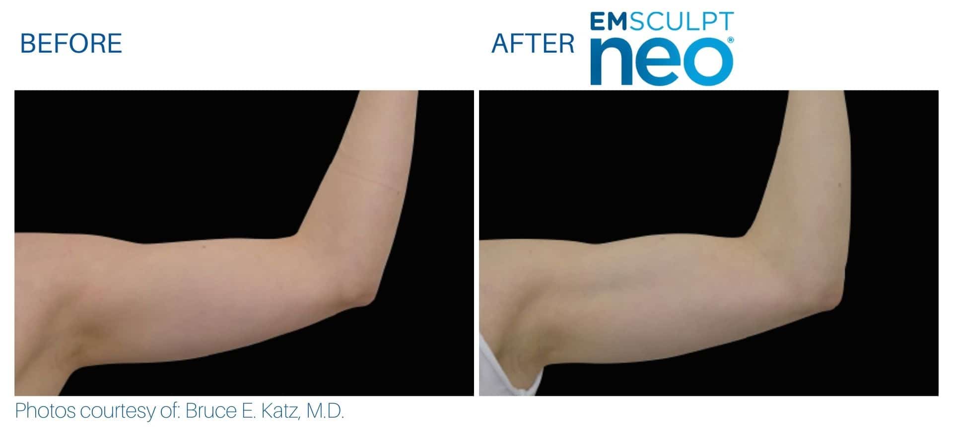 Emsculpt neo arm fat treatment before and after