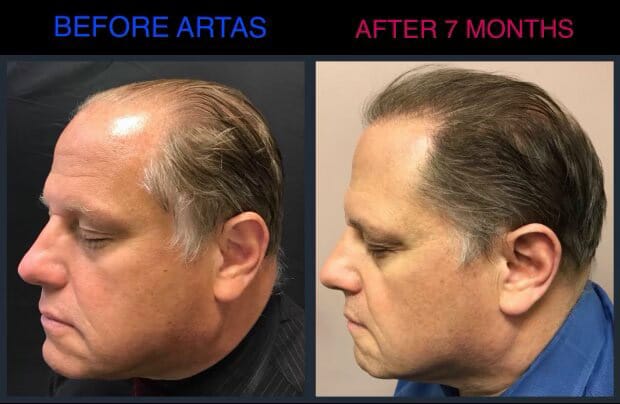 Mans before and after ARTAS ROBOTIC FUE HAIR TRANSPLANT at Laser Doc MD.