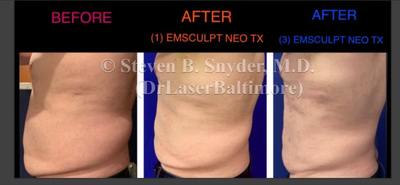 emsculpt_neo_before_and_after_dermatology_laser_center