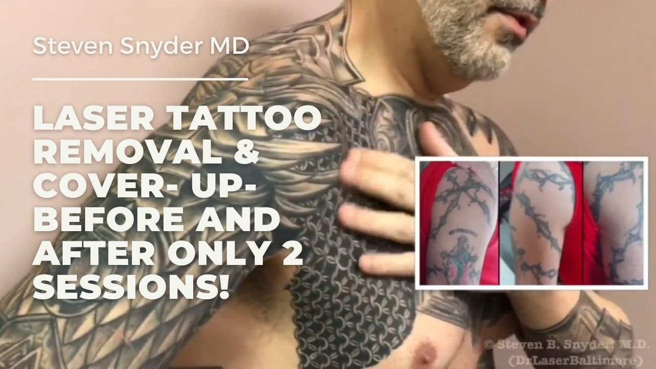 laser tattoo removal video testimonial
