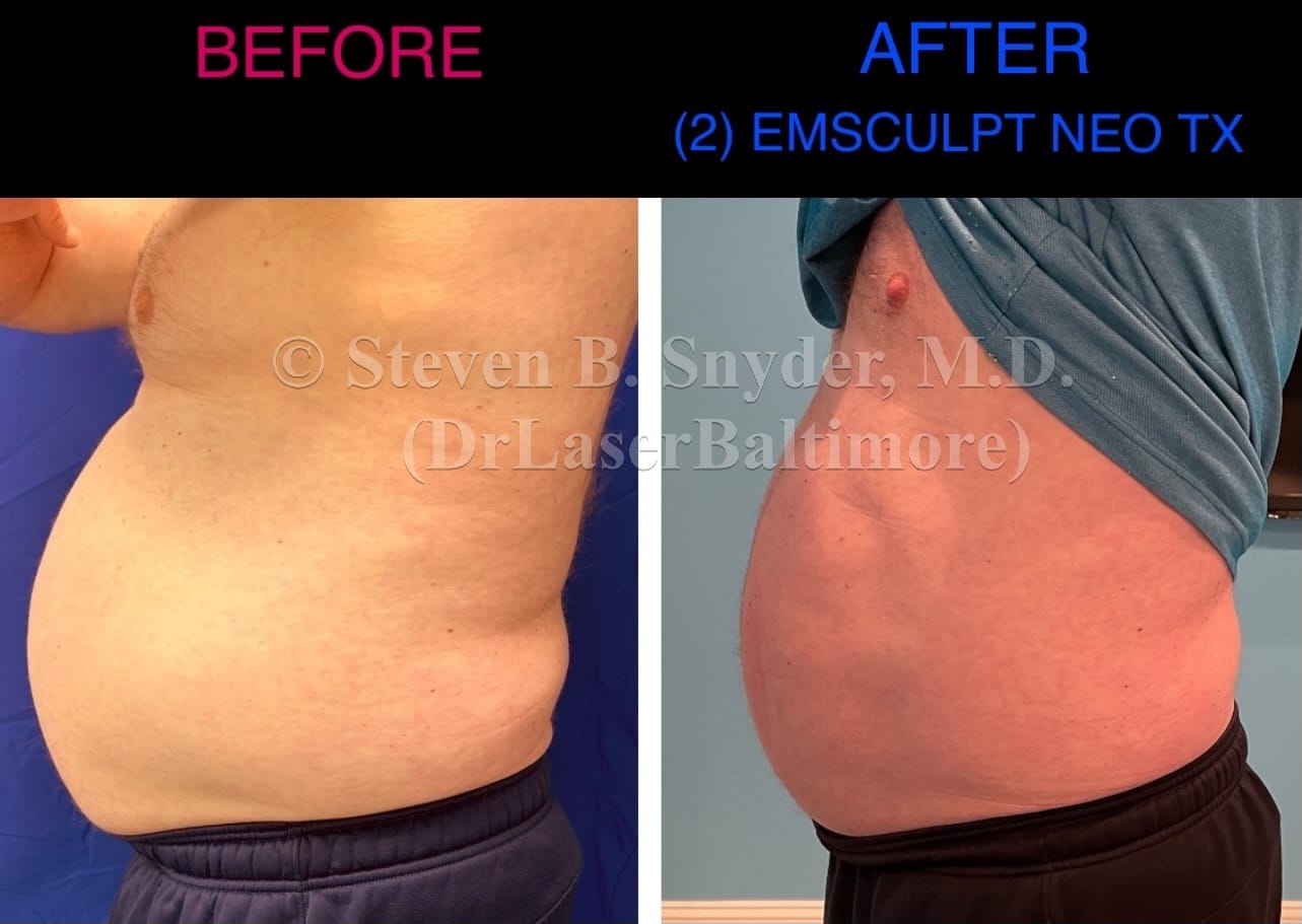 emsculpt_neo_laser_doc_md_before_and_after_04