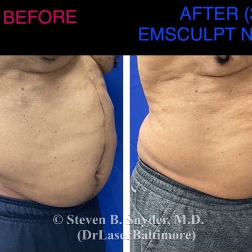 Emsculpt NEO Before And After Gallery - Dermatology Laser Center & Medispa