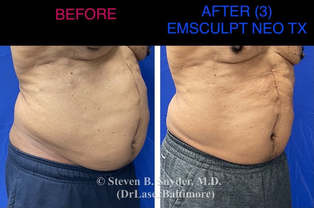 emsculpt_neo_laser_doc_md_before_and_after_08