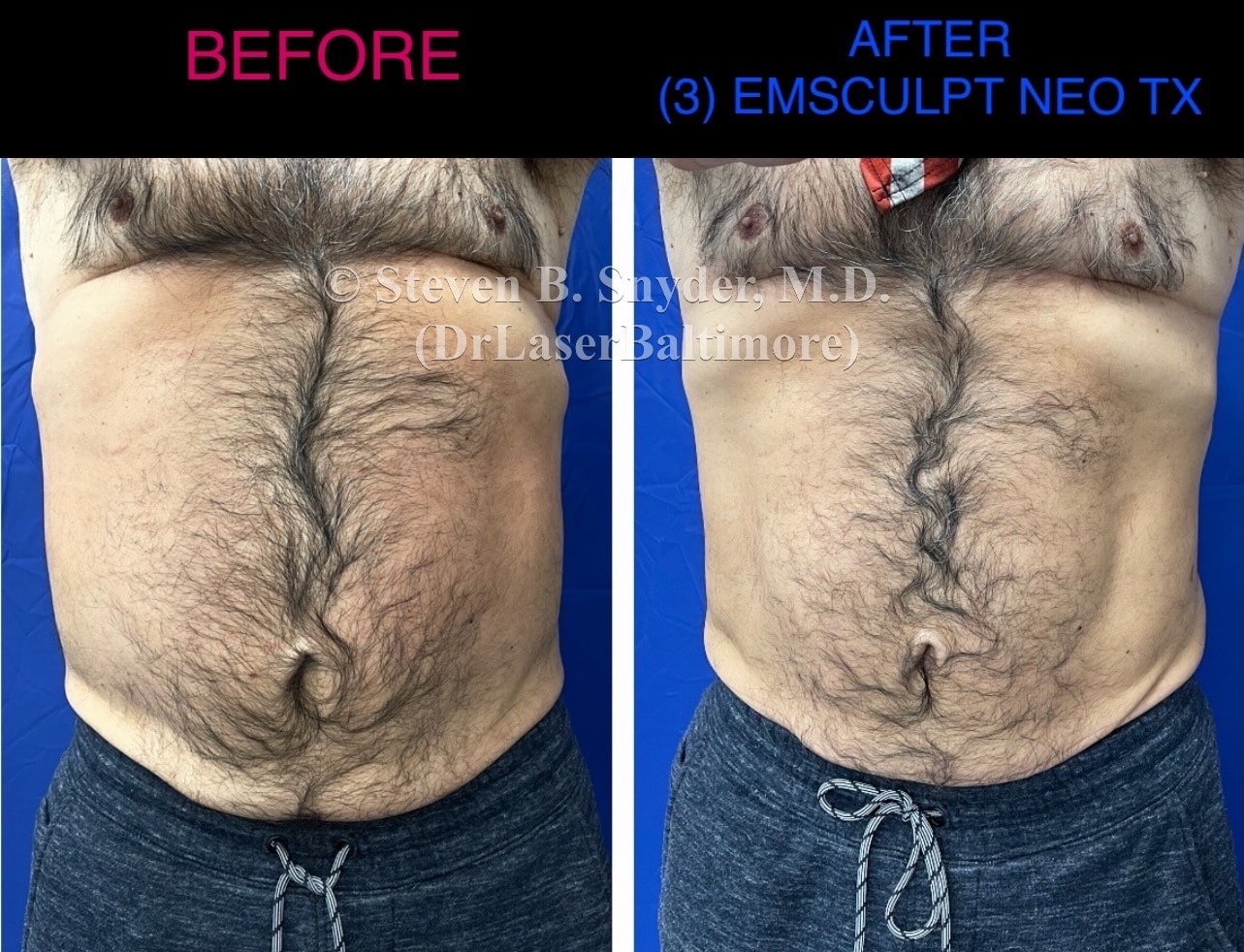 Emsculpt neo abs treatment before and after