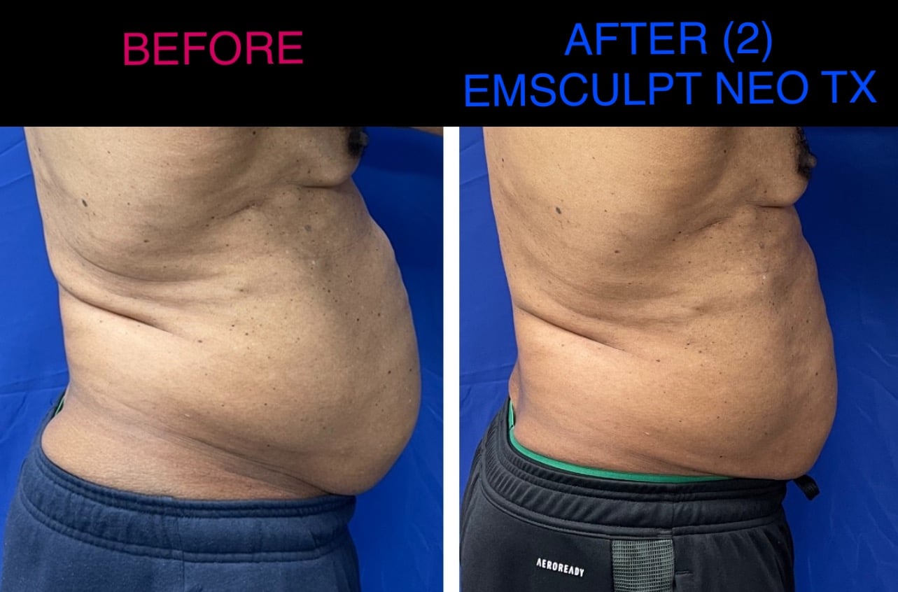 emsculpt_neo_laser_doc_md_before_and_after_18
