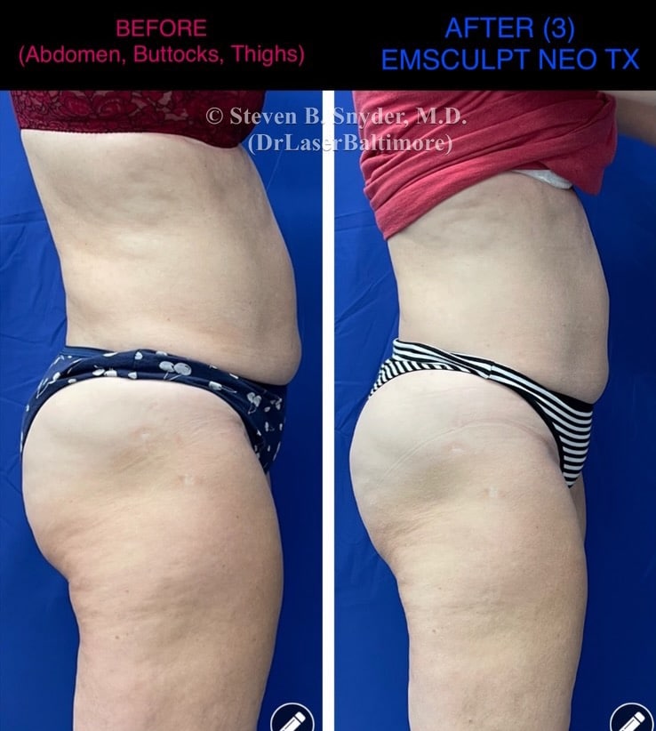 Emsculpt neo thigh treatment before and after