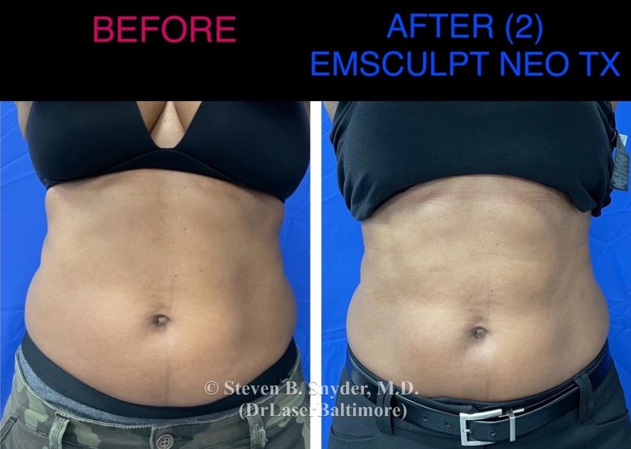 Emsculpt neo abs treatment before and after
