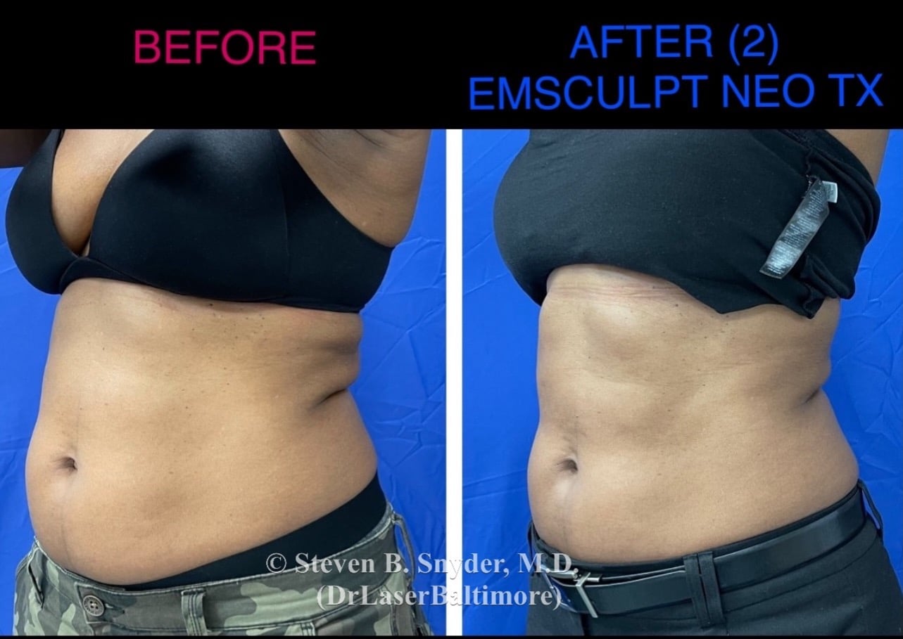 emsculpt_neo_laser_doc_md_before_and_after_22