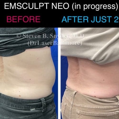 Emsculpt NEO Before And After Gallery - Dermatology Laser Center & Medispa