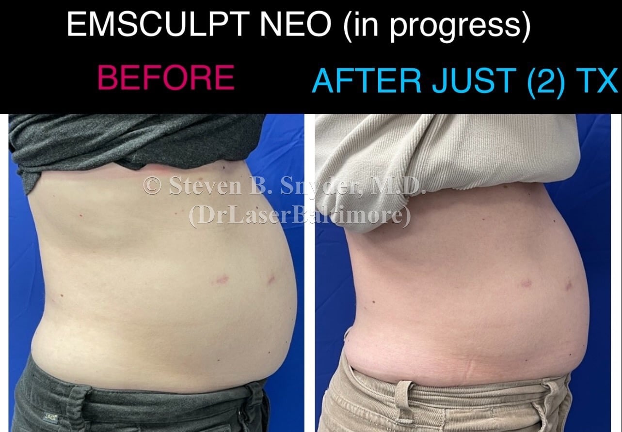 emsculpt_neo_laser_doc_md_before_and_after_26