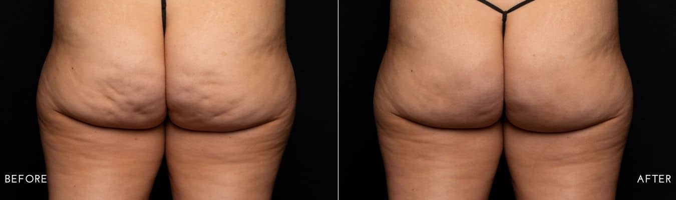 cellulite treatment in Owings Mills, MD