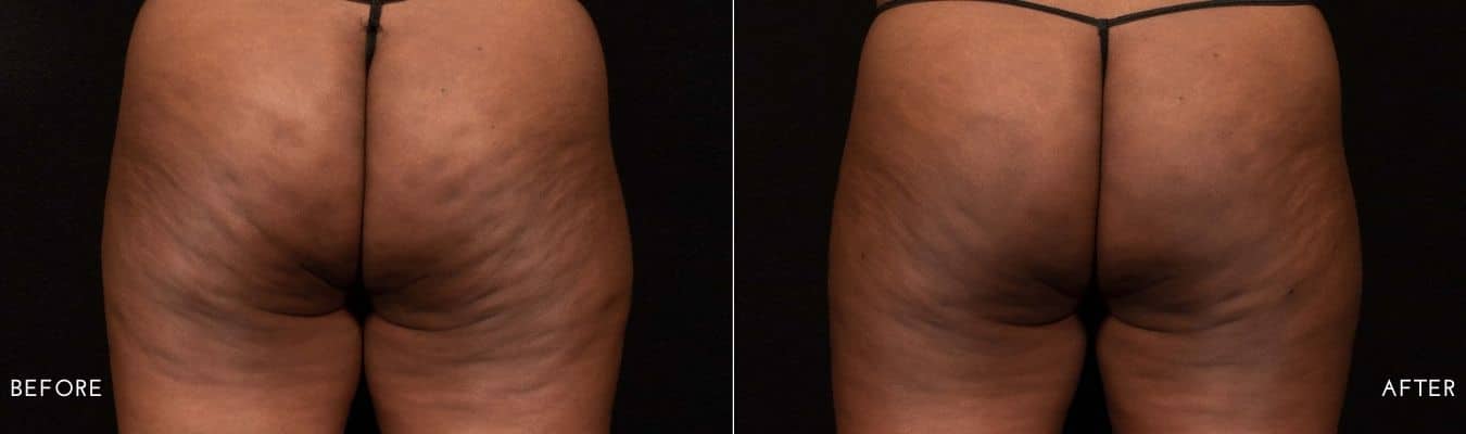 Avéli cellulite treatment in Owings Mills, MD