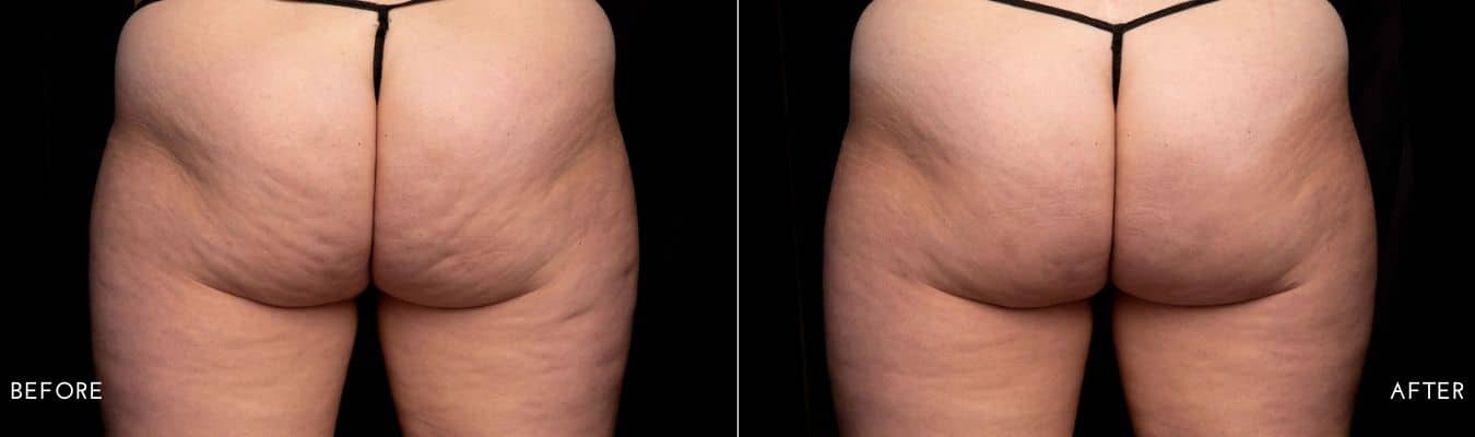 Avéli Cellulite Treatment Before and After Photos
