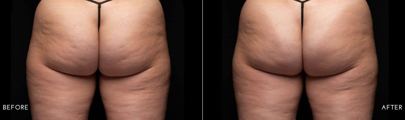 Avéli Cellulite Treatment Before and After