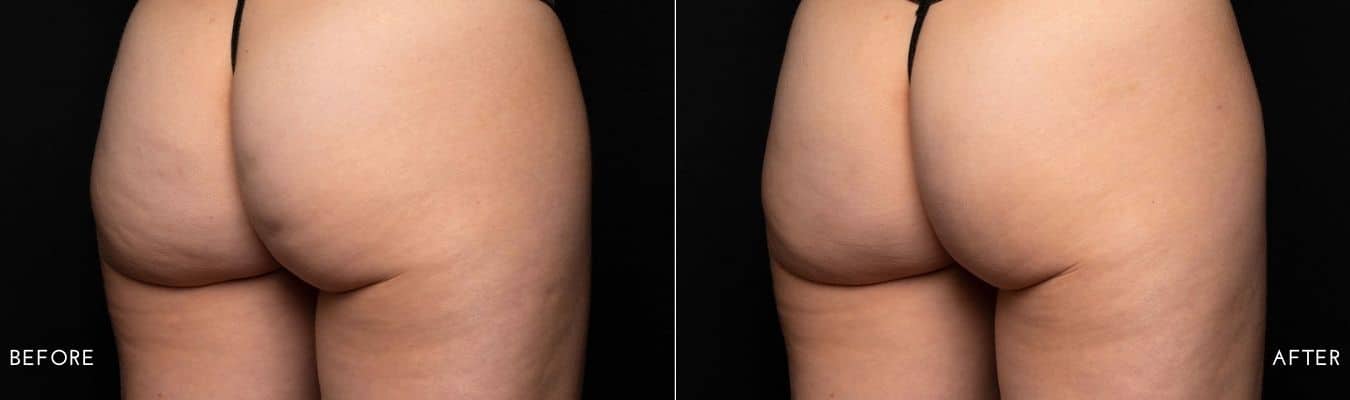 Avéli cellulite treatment before and after image 7
