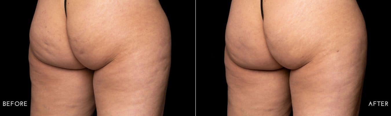 Avéli cellulite treatment before and after image 8
