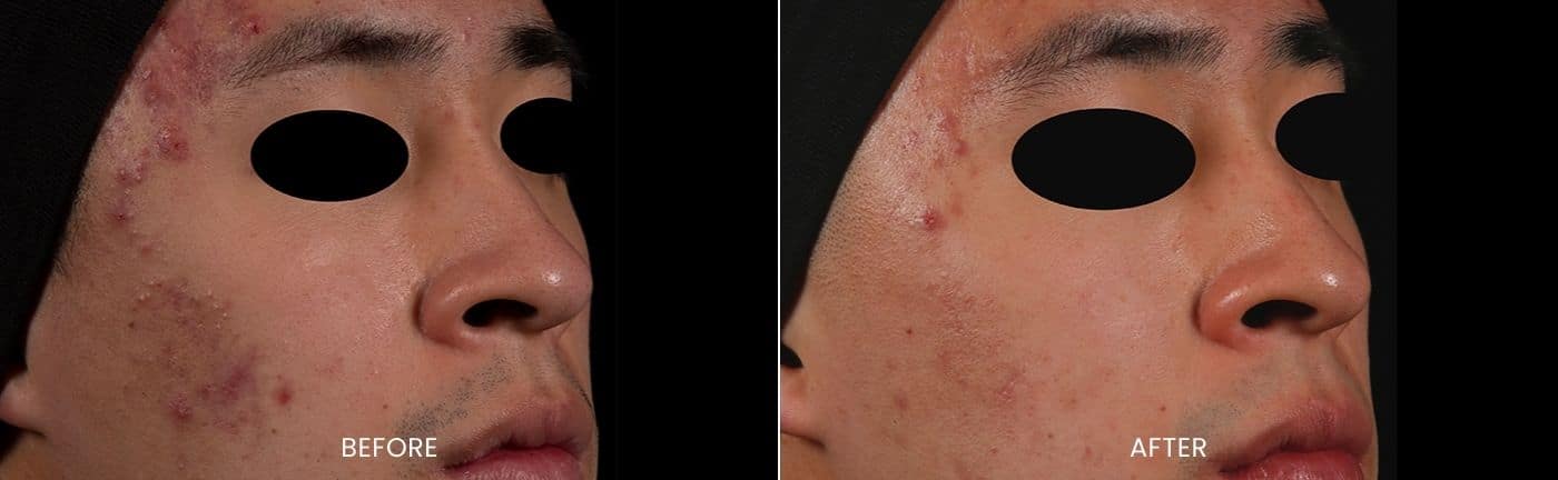 AviClear acne treatment before and after (3)
