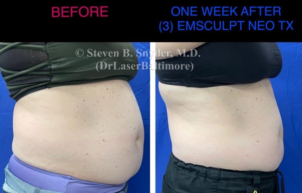 Why Emsculpt is the Best Abdominal Toning and Strengthening