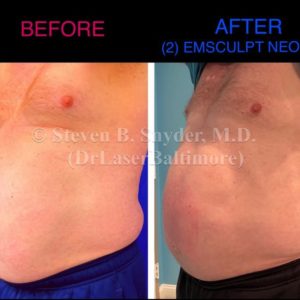 Emsculpt NEO Before And After | Real Patient Results