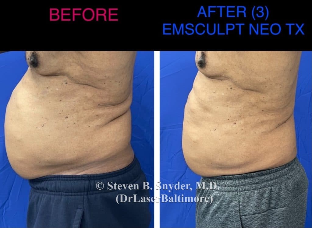 Emsculpt Before And After Real Patient Results, 54% OFF