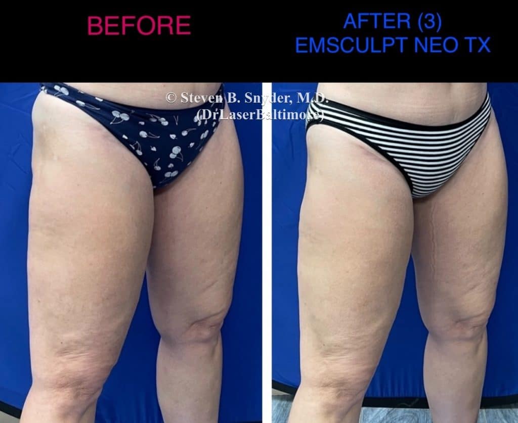 Emsculpt neo thigh treatment before and after