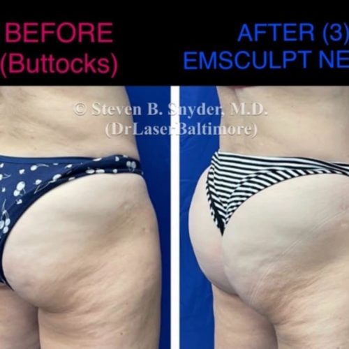 Emsculpt neo buttocks treatment before and after