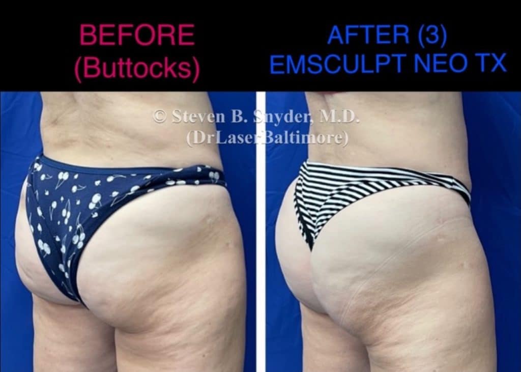 Emsculpt neo buttocks treatment before and after