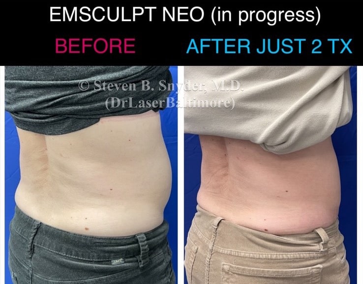 5 Possible Results From EMSCULPT Treatment, by ALLURE LASER STUDIO