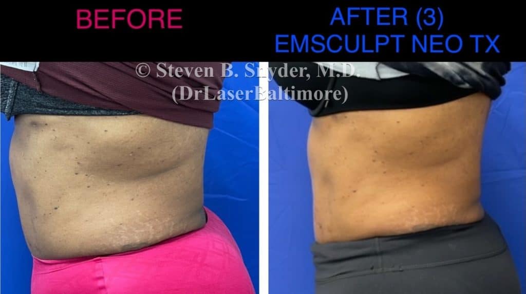 The cost of Emsculpt Neo Vs. other body contouring treatments