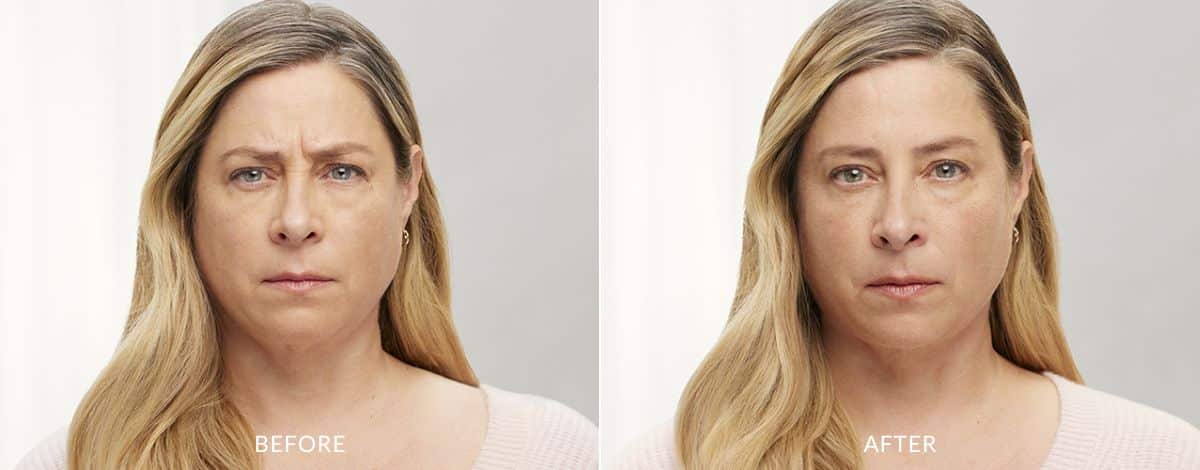 Before and after image showing a woman's forehead with frown lines before and smooth, wrinkle-free skin after Botox treatment in Baltimore.