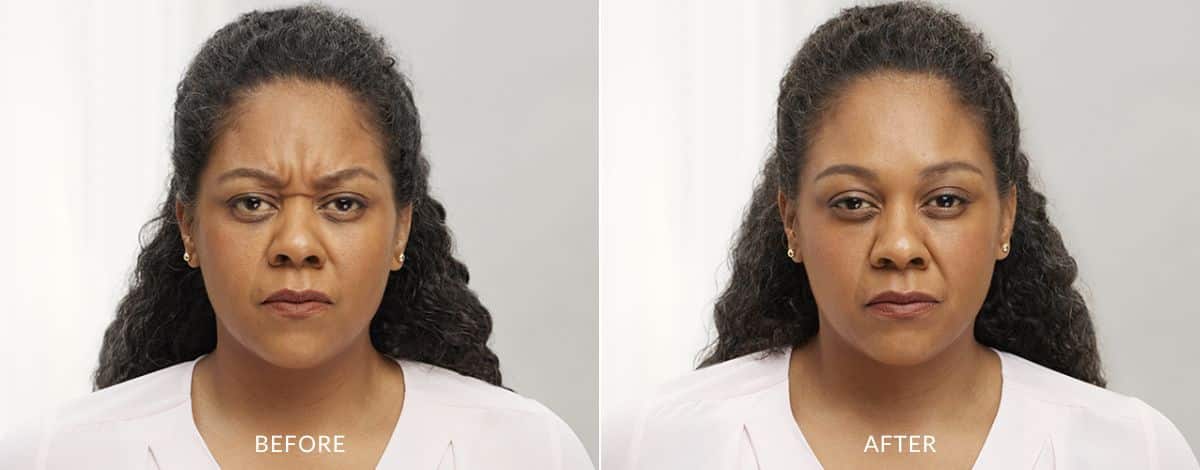 Before and after photos of a woman with frown lines between her brows before and no lines after Botox treatment in Maryland.