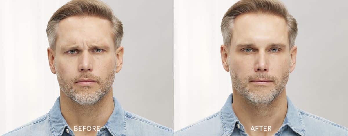 Before and after photos showing a man with frown lines before and smooth, wrinkle-free skin after Botox treatment in Baltimore.