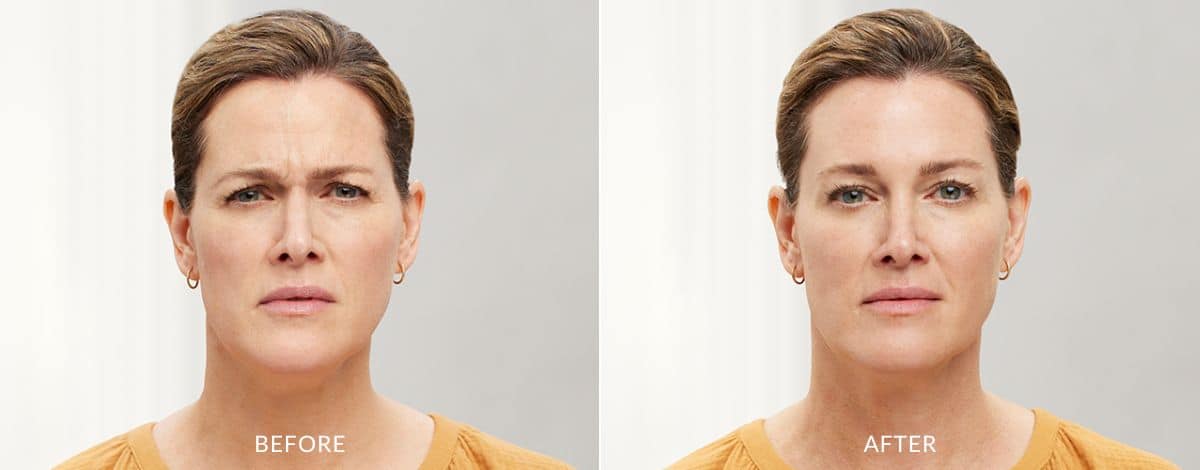 Before and after photos showing frown lines between a woman's brows before and no lines after Botox treatment in MD.
